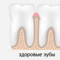 Vaikų dantenų uždegimo simptomai ir dantenų ligų gydymo būdai namuose